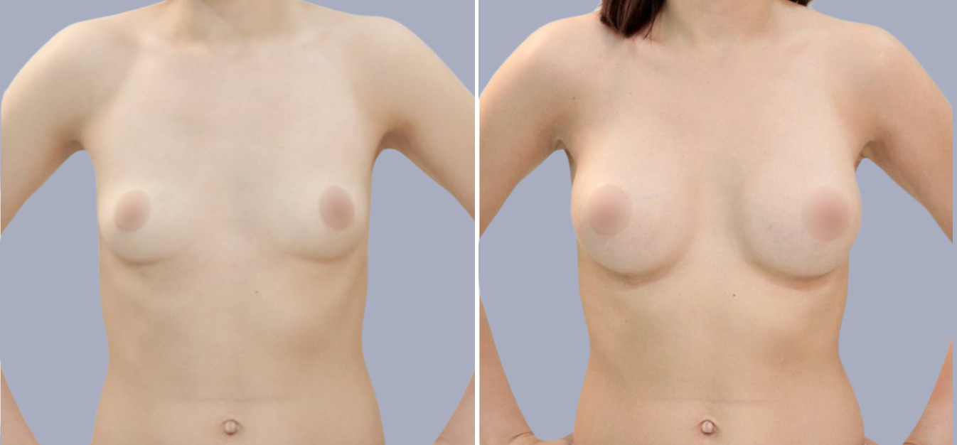 Фоторезультаты: увеличение груди до и после изображение 6