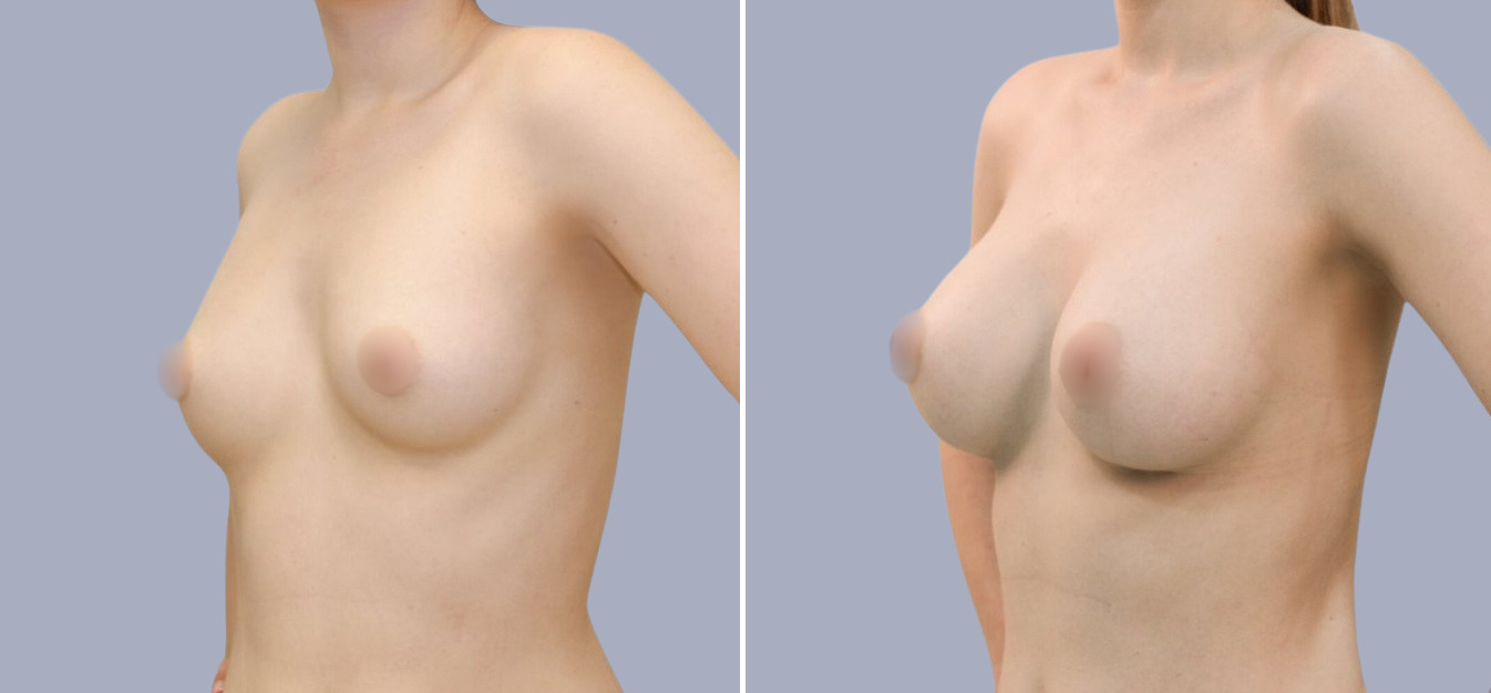 Фоторезультаты: увеличение груди до и после изображение 7