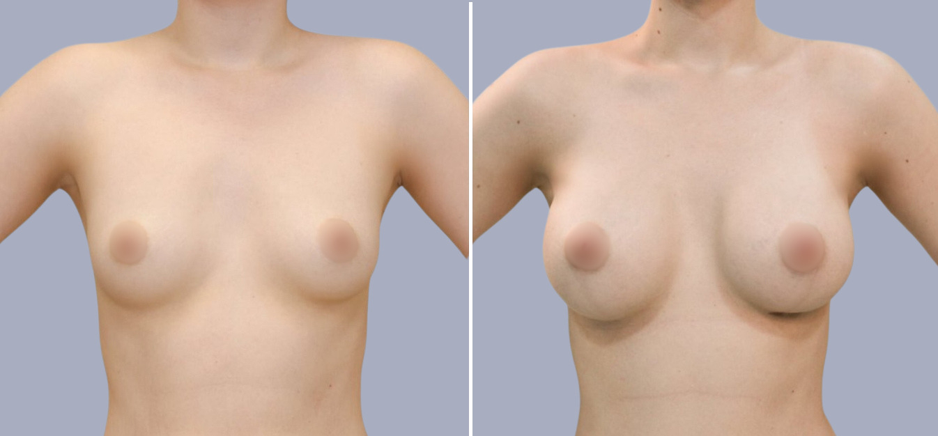 Фоторезультаты: увеличение груди до и после изображение 8
