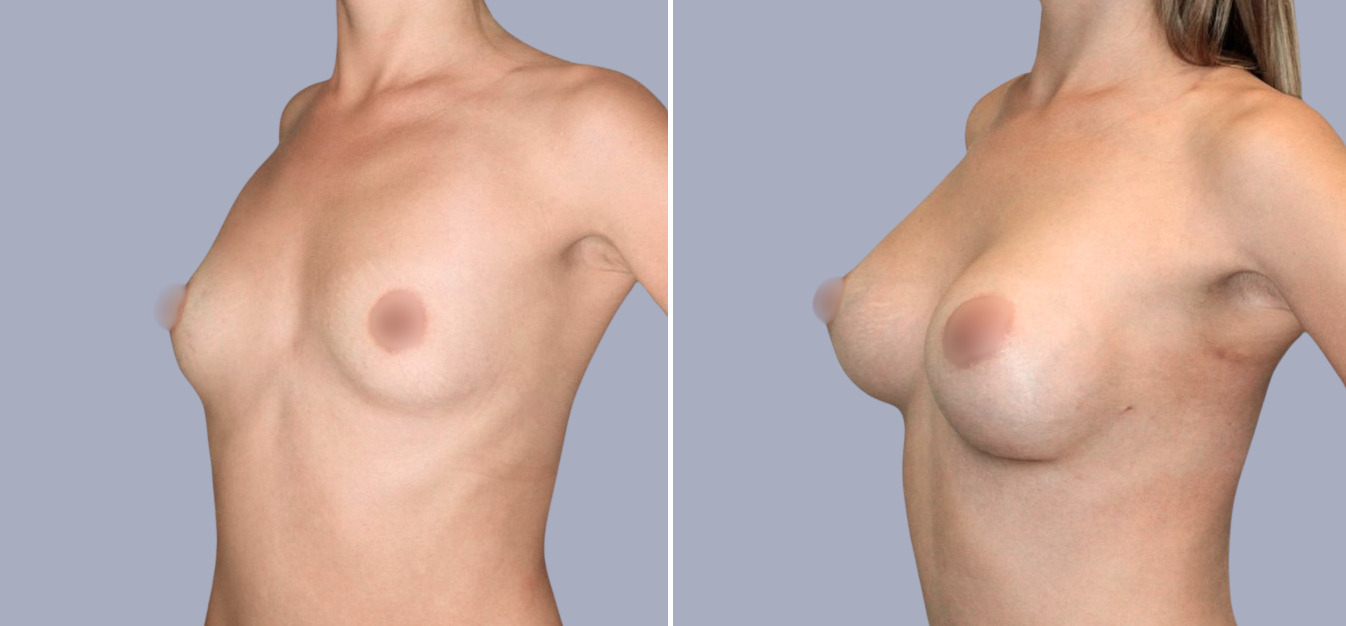 Фоторезультаты: увеличение груди до и после изображение 10