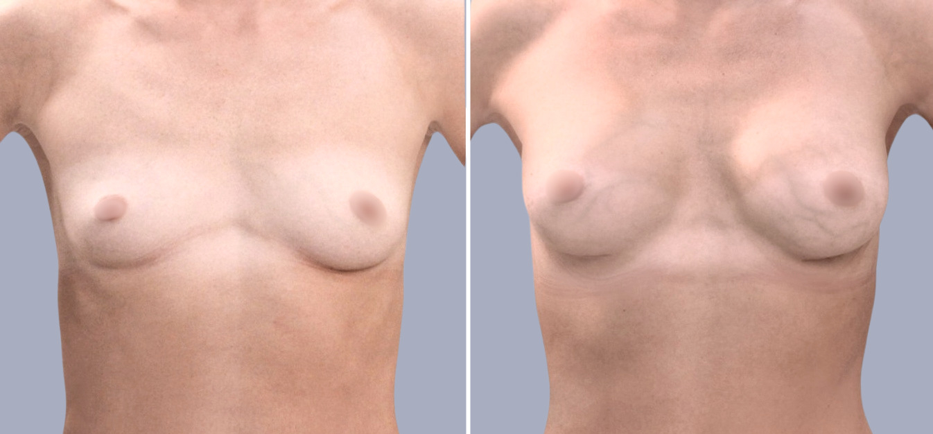 Фоторезультаты: увеличение груди до и после изображение 12