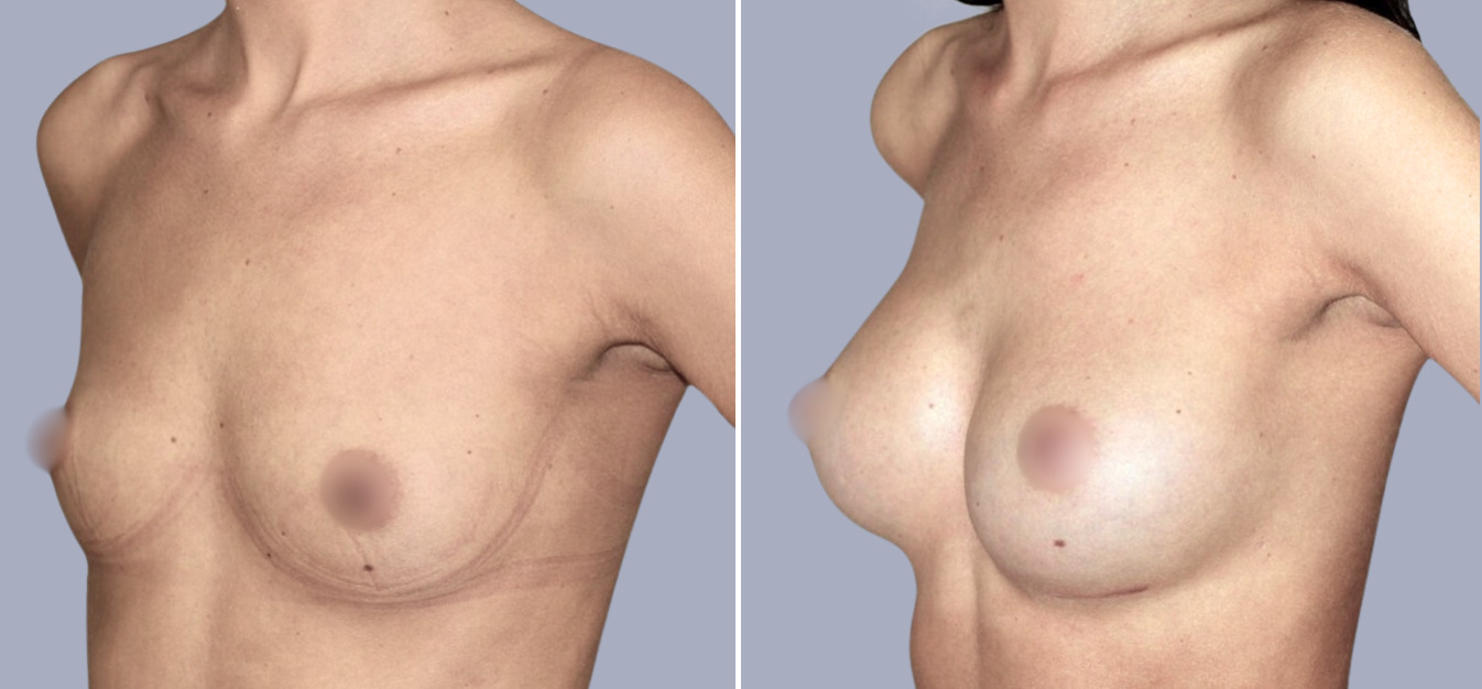 Фоторезультаты: увеличение груди до и после изображение 0