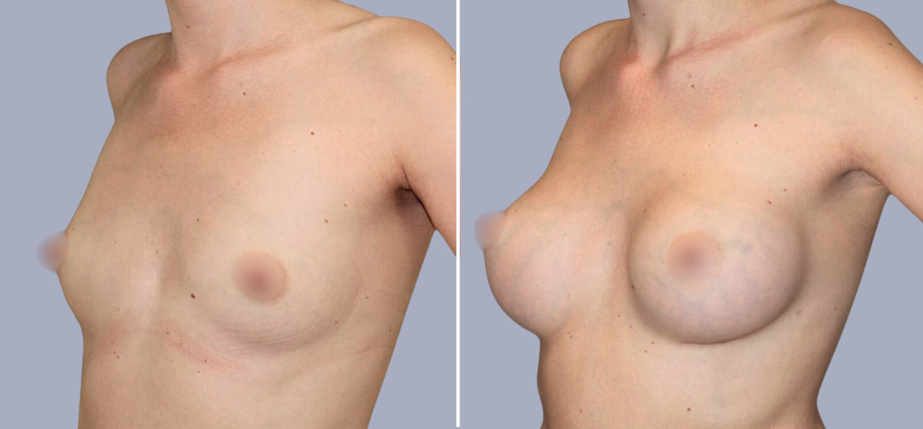 Фоторезультаты: увеличение груди до и после изображение 1