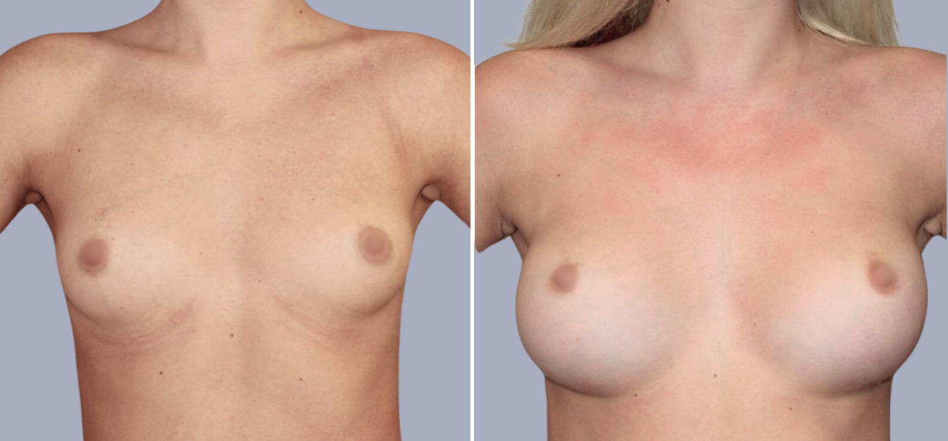 Фоторезультаты: увеличение груди до и после изображение 2