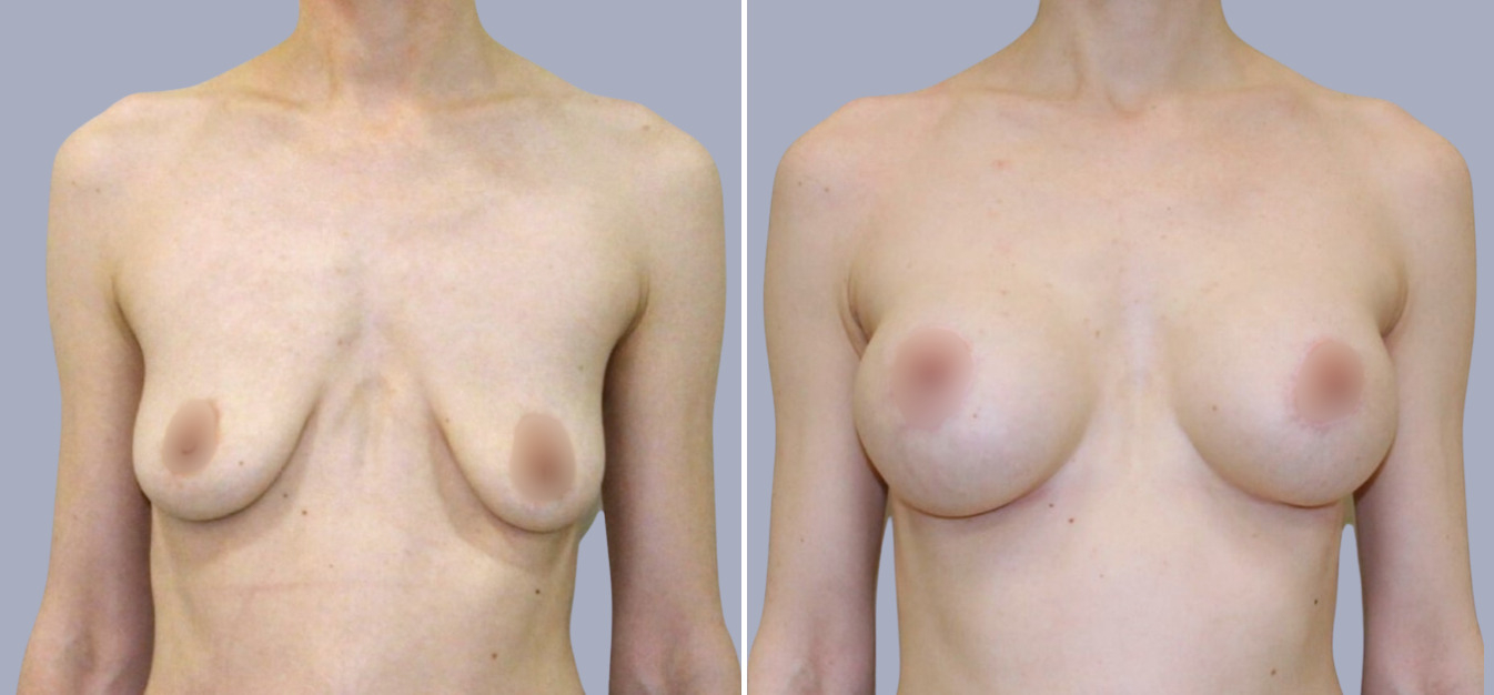 Фоторезультаты: подтяжка груди до и после изображение 0