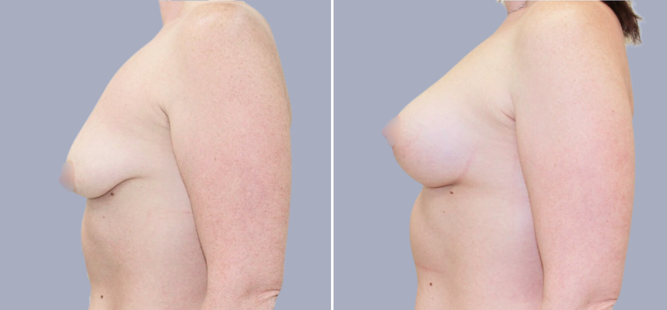 Фоторезультаты: подтяжка груди до и после изображение 2