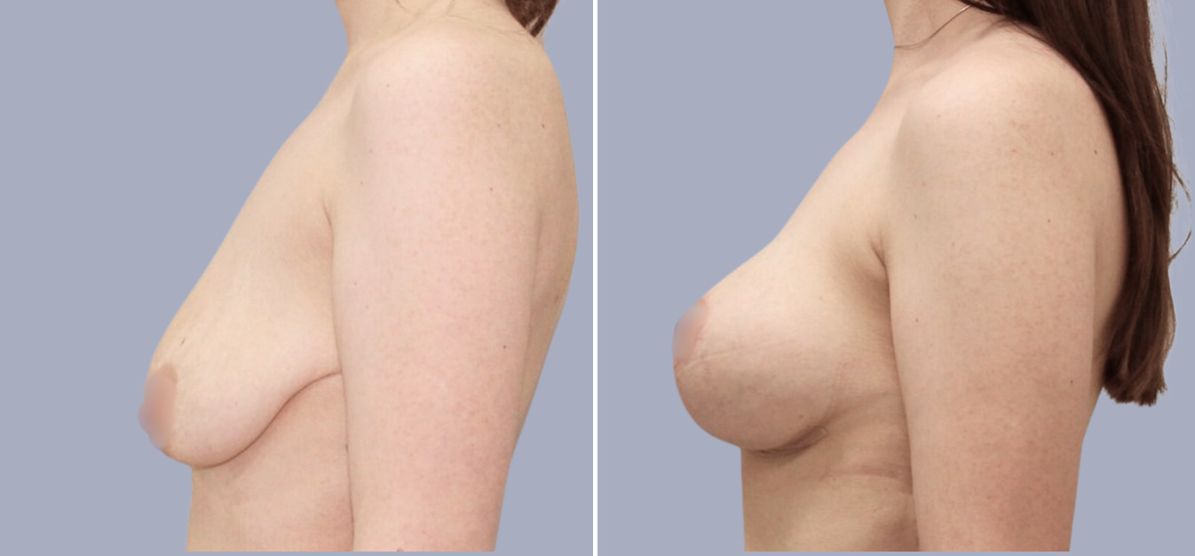 Фоторезультаты: подтяжка груди до и после изображение 3