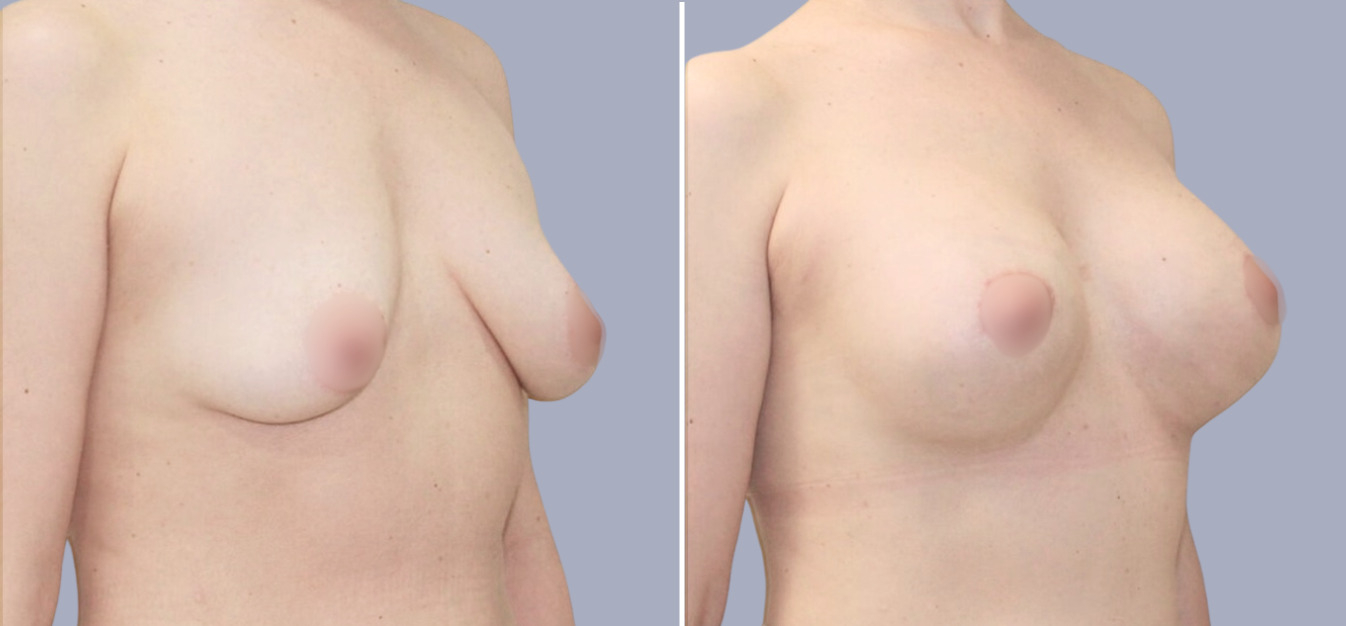 Фоторезультаты: подтяжка груди до и после изображение 4
