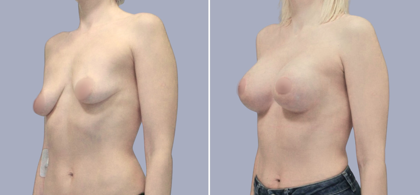 Фоторезультаты: подтяжка груди до и после изображение 5
