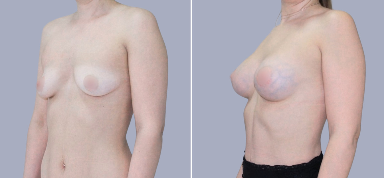 Фоторезультаты: подтяжка груди до и после изображение 6