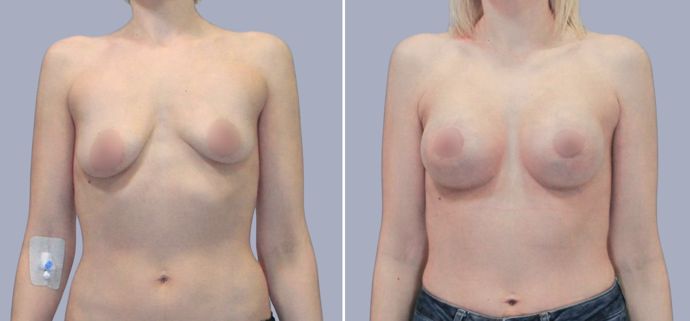 Фоторезультаты: подтяжка груди до и после изображение 7