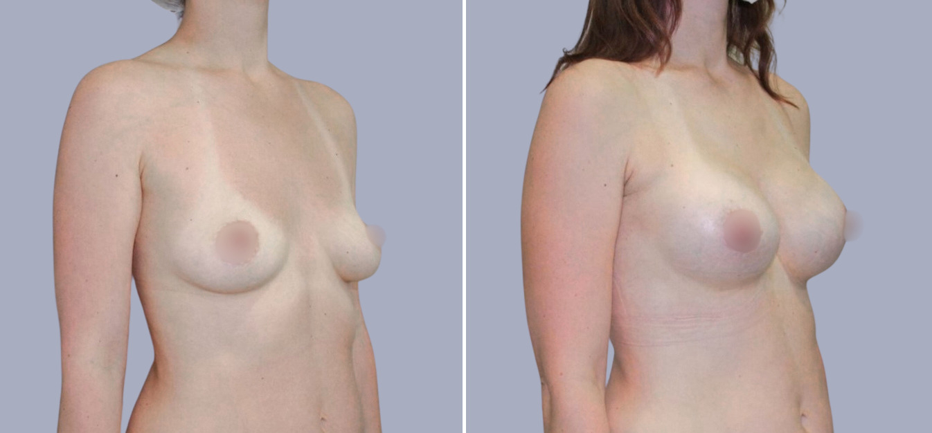 Фоторезультаты: подтяжка груди до и после изображение 8