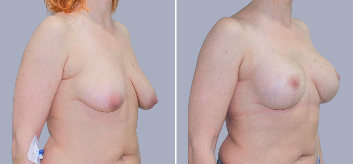 Фоторезультаты: подтяжка груди до и после изображение 9