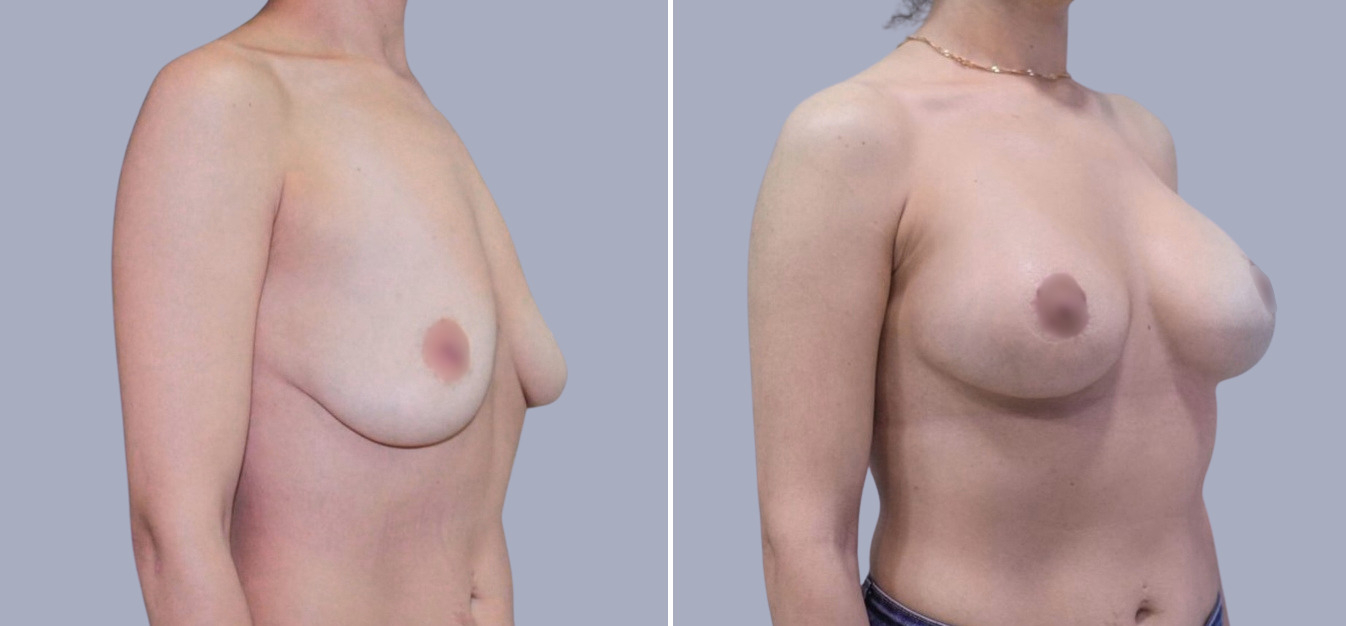 Фоторезультаты: подтяжка груди до и после изображение 10