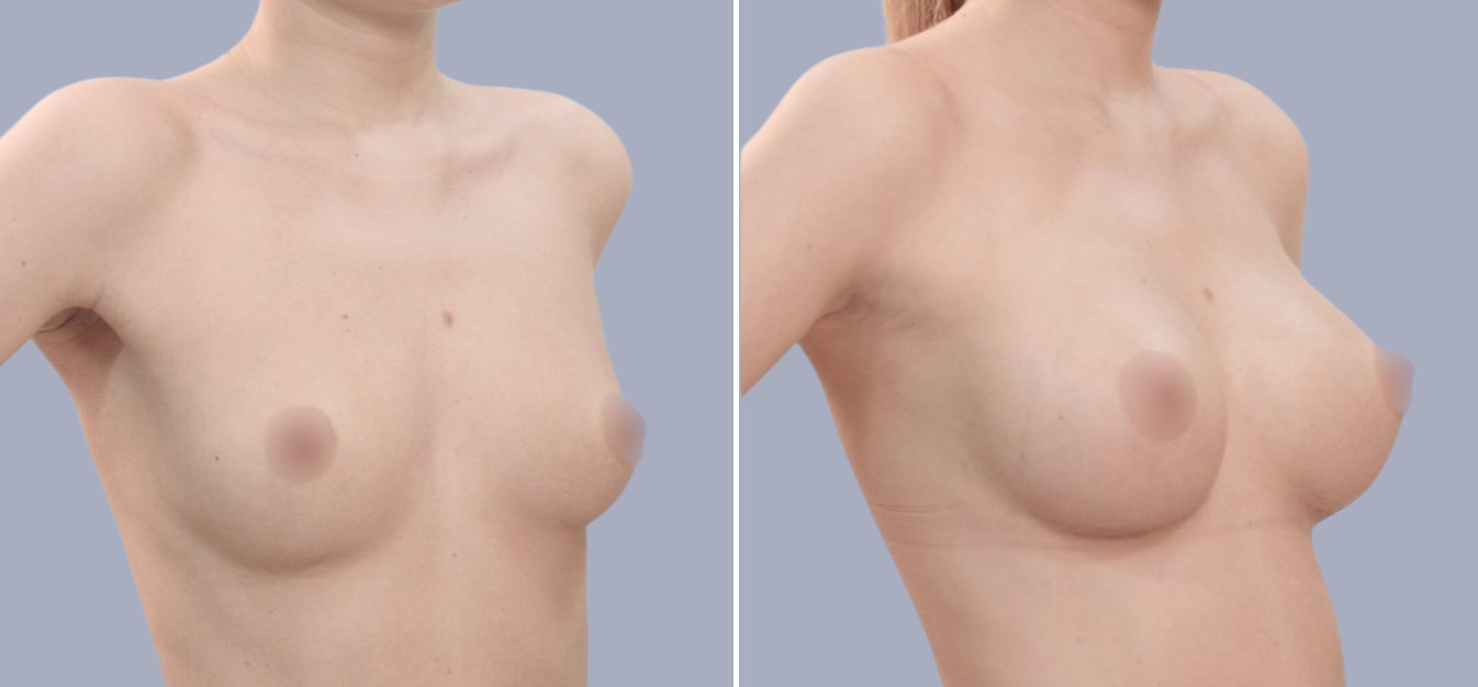 Фоторезультаты: увеличение груди до и после изображение 4