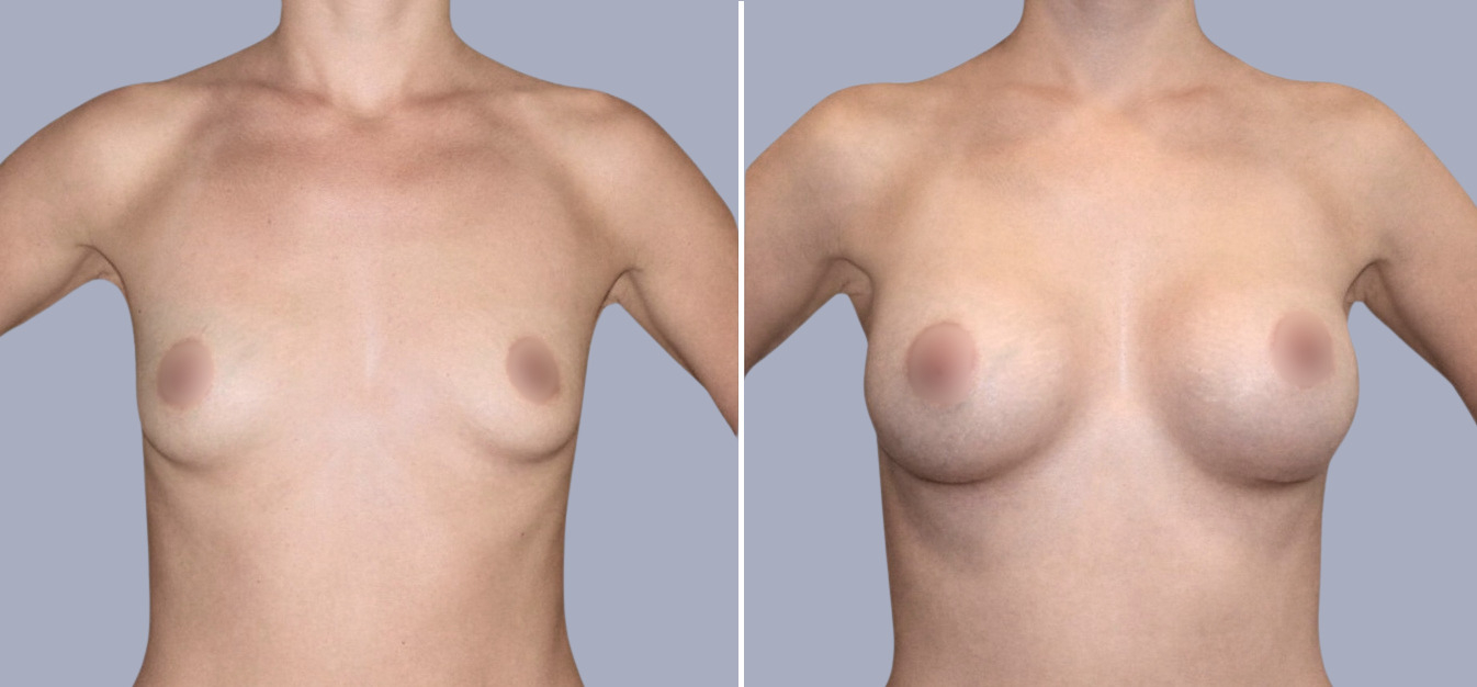 Фоторезультаты: увеличение груди до и после изображение 9