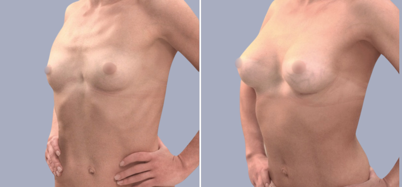 Фоторезультаты: увеличение груди до и после изображение 11