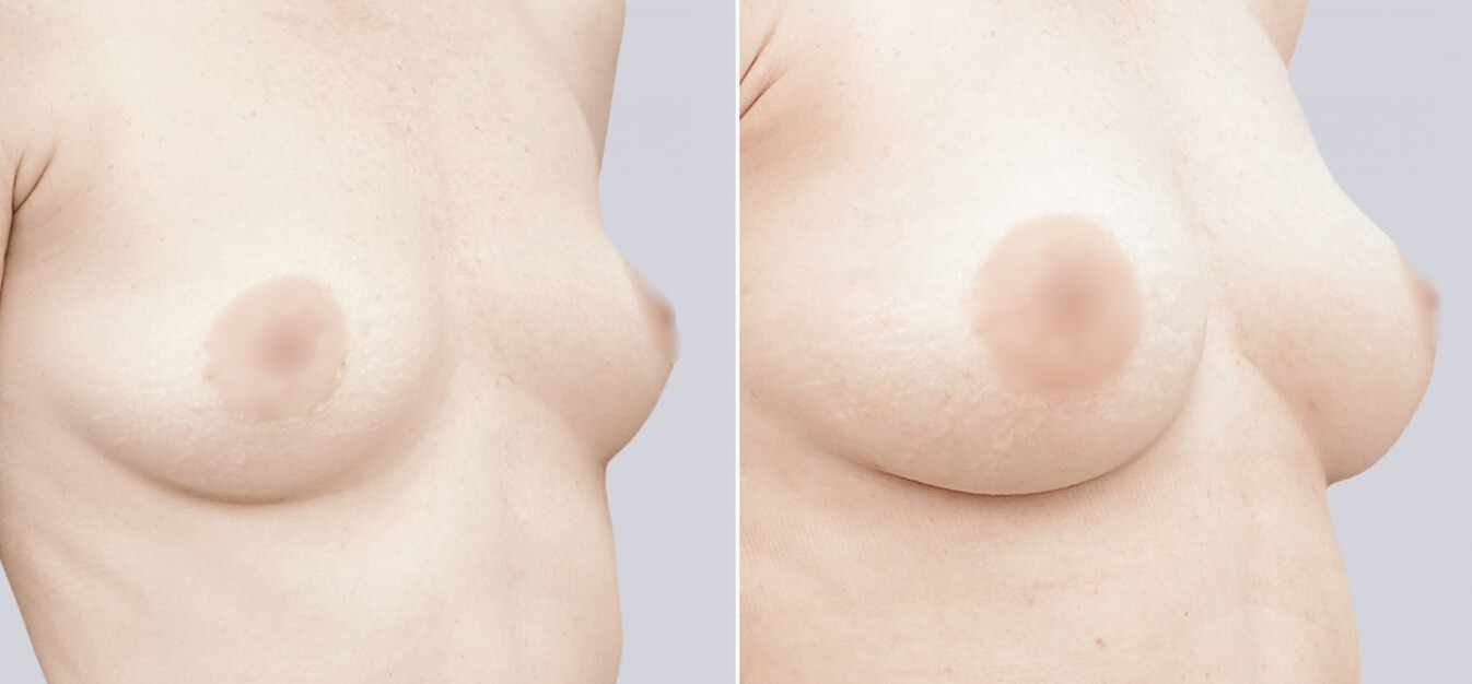 Липофилинг груди до и после изображение 0