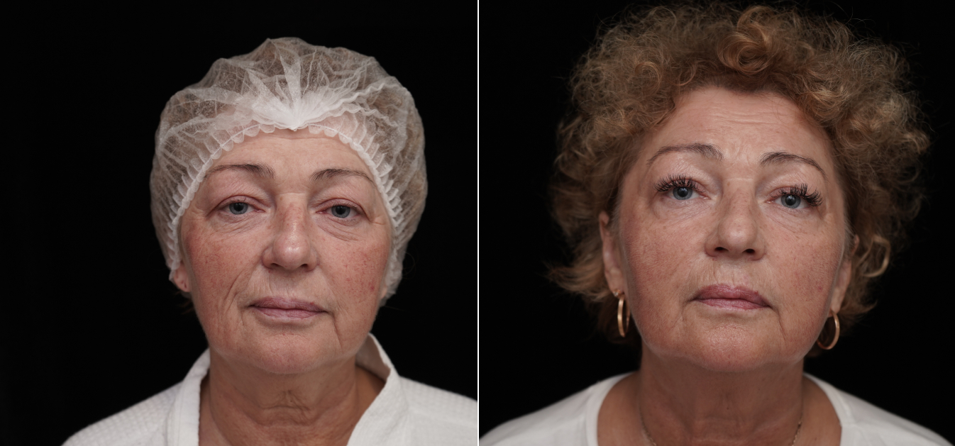 Фоторезультаты: липофилинг лица до и после изображение 9