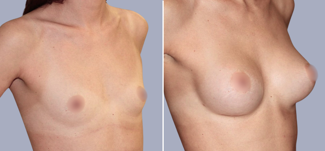 Фоторезультаты: увеличение груди до и после изображение -1