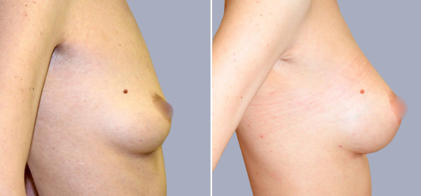 Фоторезультаты: увеличение груди до и после изображение 3