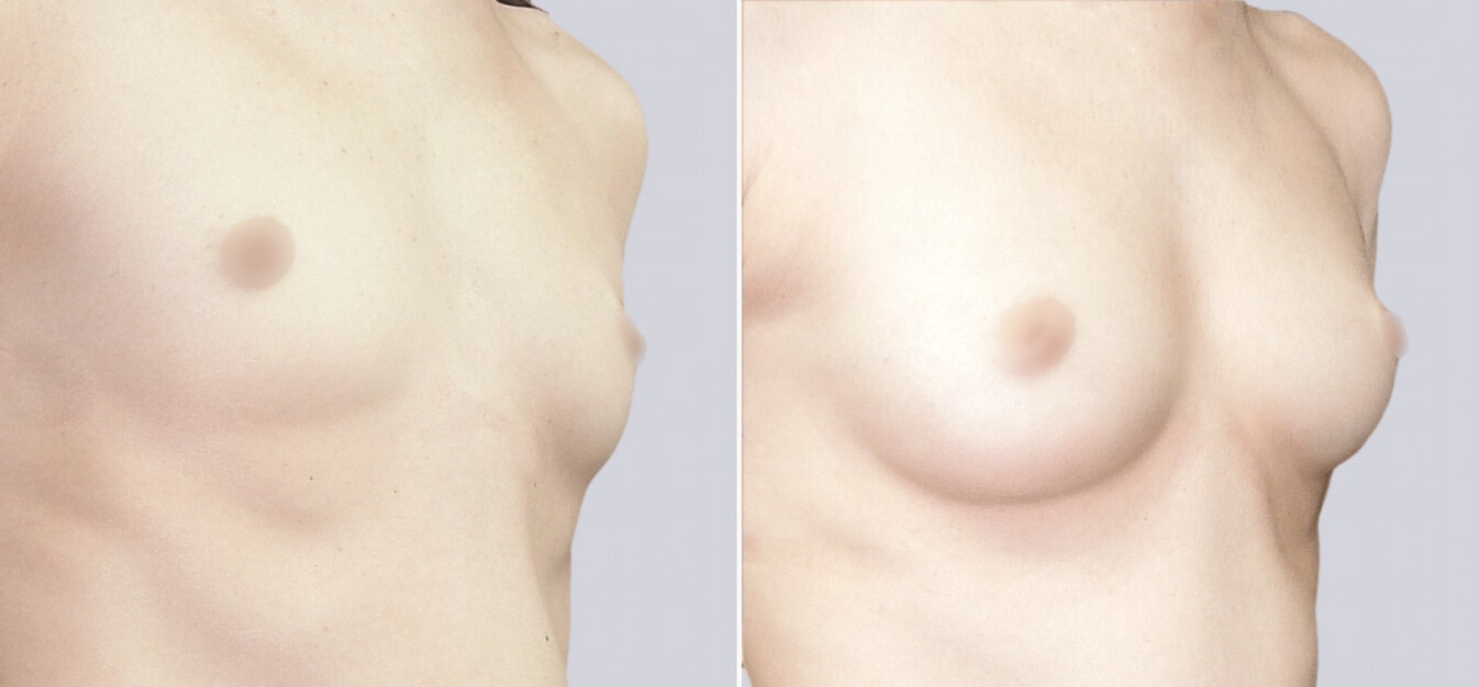 Липофилинг груди до и после изображение 3