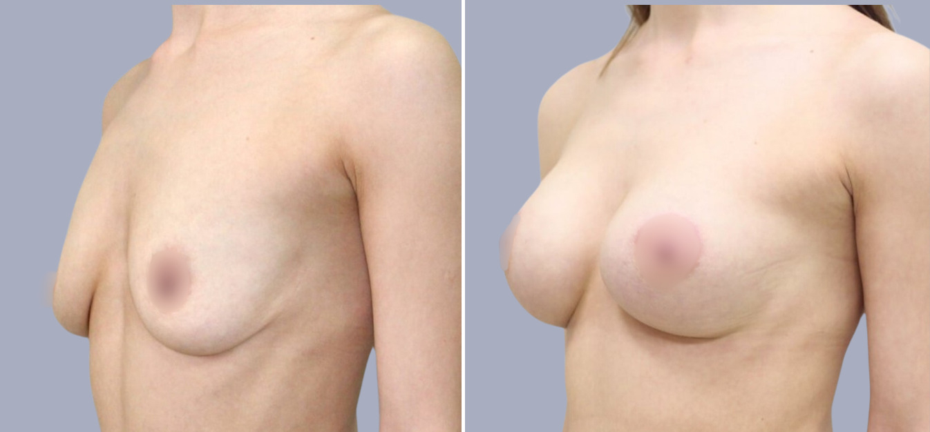 Фоторезультаты: подтяжка груди до и после изображение -1