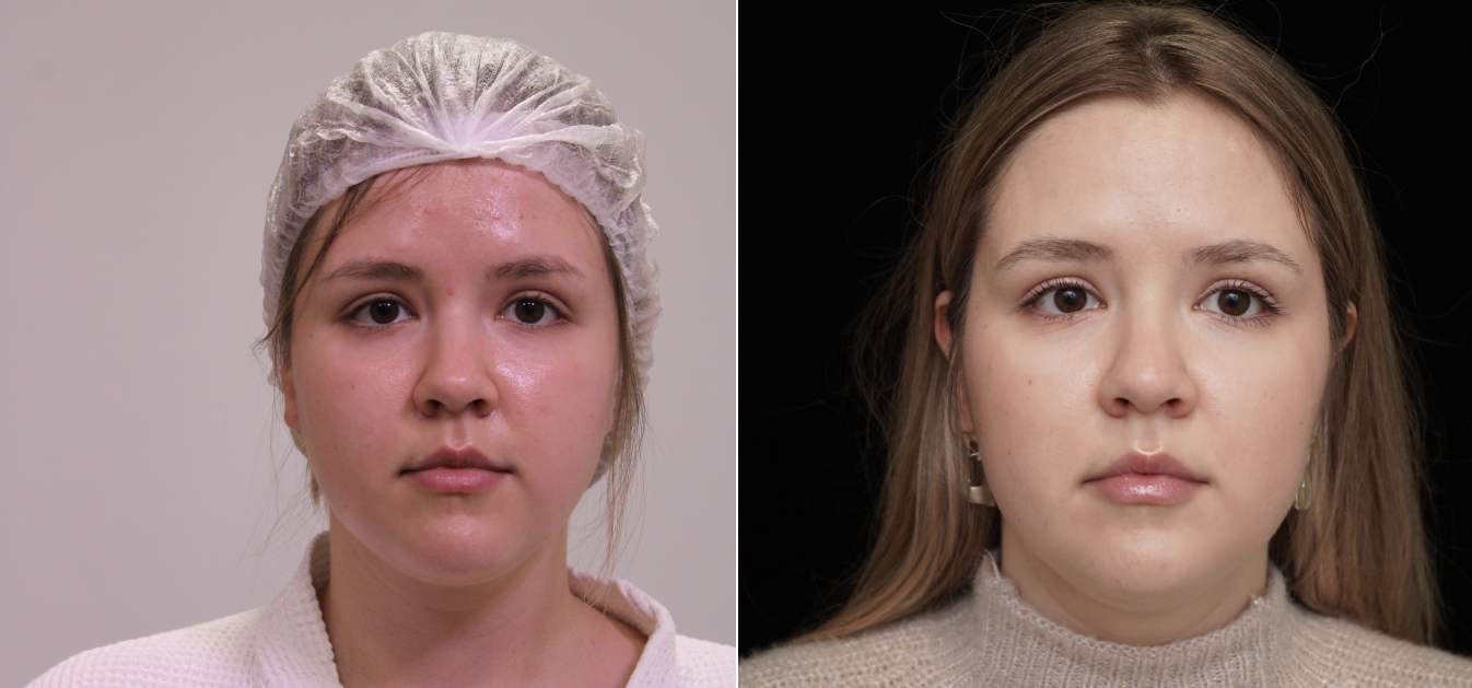 Фоторезультаты: липофилинг лица до и после изображение 10