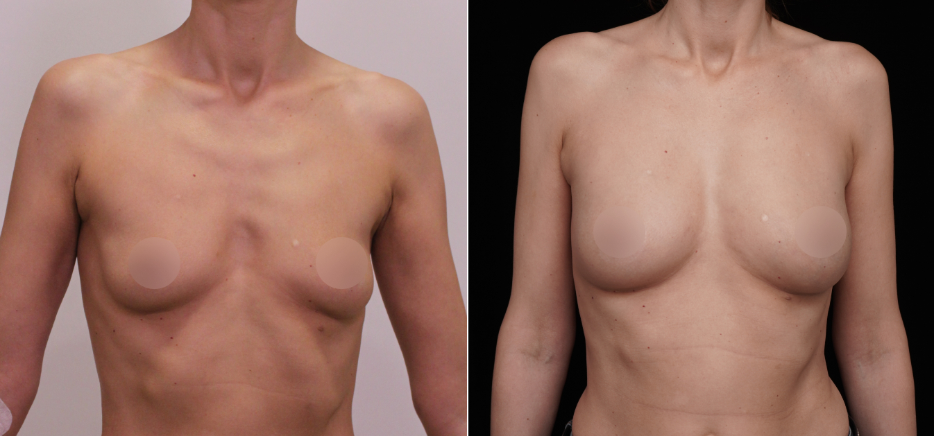 Липофилинг груди до и после изображение 4