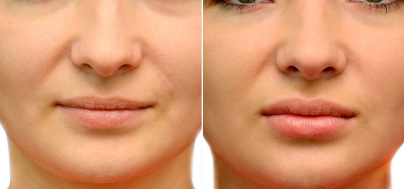 Фоторезультаты: липофилинг лица до и после изображение 1