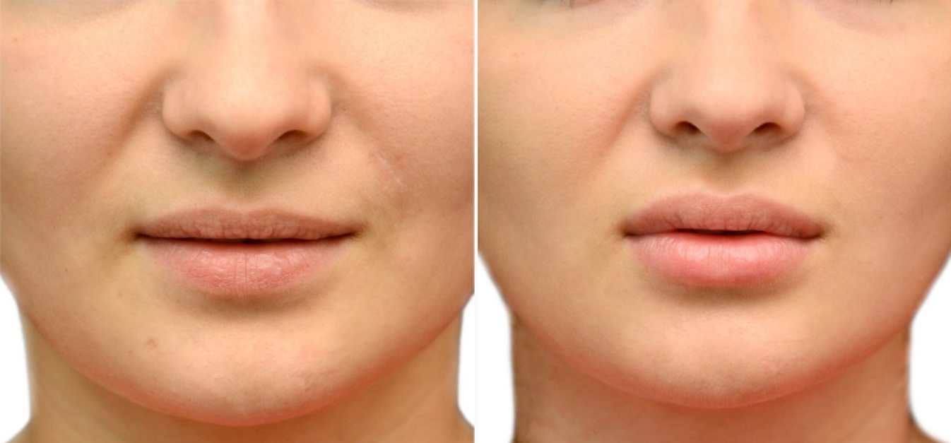 Фоторезультаты: липофилинг лица до и после изображение 2