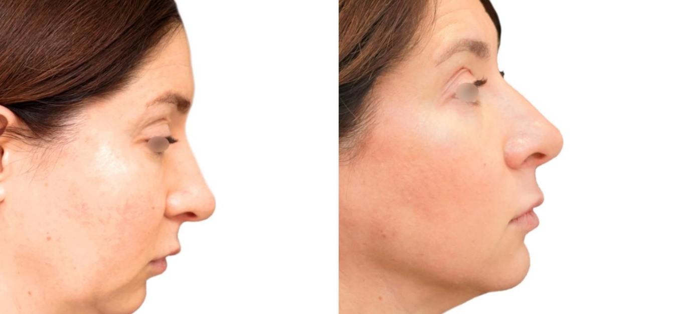 Фоторезультаты: липофилинг лица до и после изображение 4