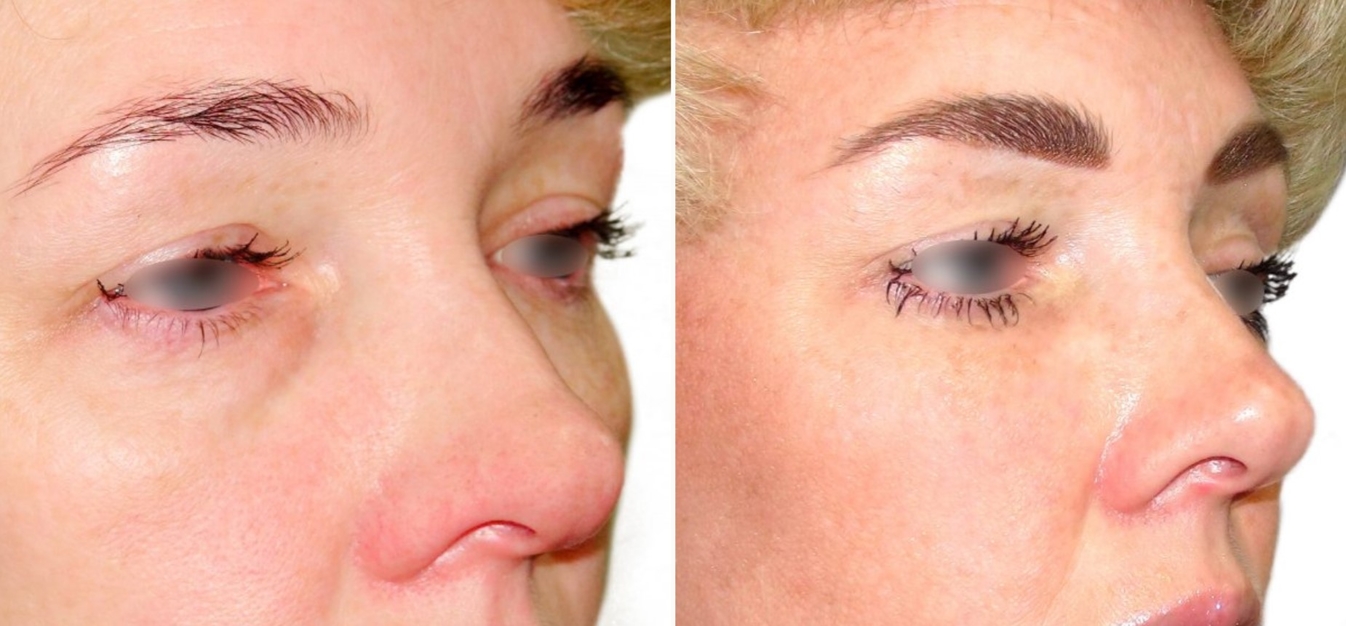 Фоторезультаты: липофилинг лица до и после изображение 8